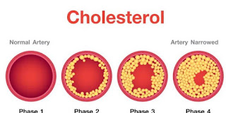 Pengertian Kolesterol dan Jenis Makanan Yang Mengandung Kolestrerol
