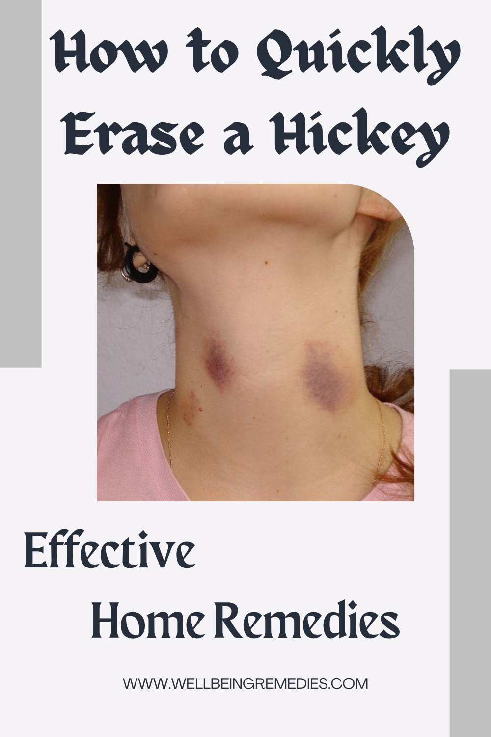 How to Quickly Erase a Hickey: Effective Home Remedies