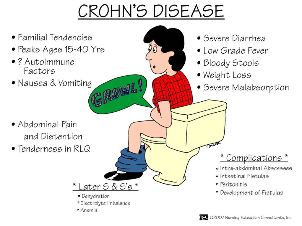 Crohn’s disease treatment