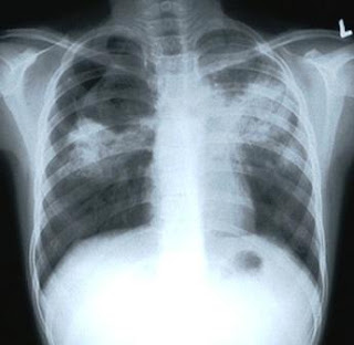 Tuberculosis xray