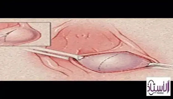 Bartholin's-gland-in-the-female-genital-area