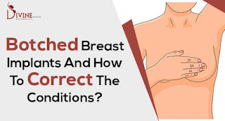 Fix a Botched Breast Job with Breast Revision