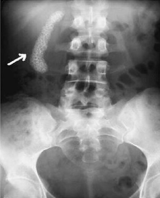 gambar hasil foto polos (rontgen) abdomen pada pasien kolelitiasis, batu kolesterol, pigmen, campuran, diagnosis, radiologi, regio kuadran kanan atas, batu multiple, X-ray, sinar X, pencitraan, radiologi, pemeriksaan penunjang rumah sakit, klinik, puskesmas, bpjs, jkn-kis