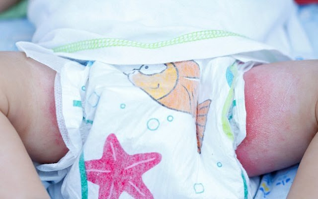 Tak Pernah Ganti Popok Selama Berbulan-bulan, Bayi 4 Bulan Meninggal Secara Tragis