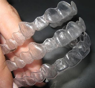 gia-nieng-rang-invisalign