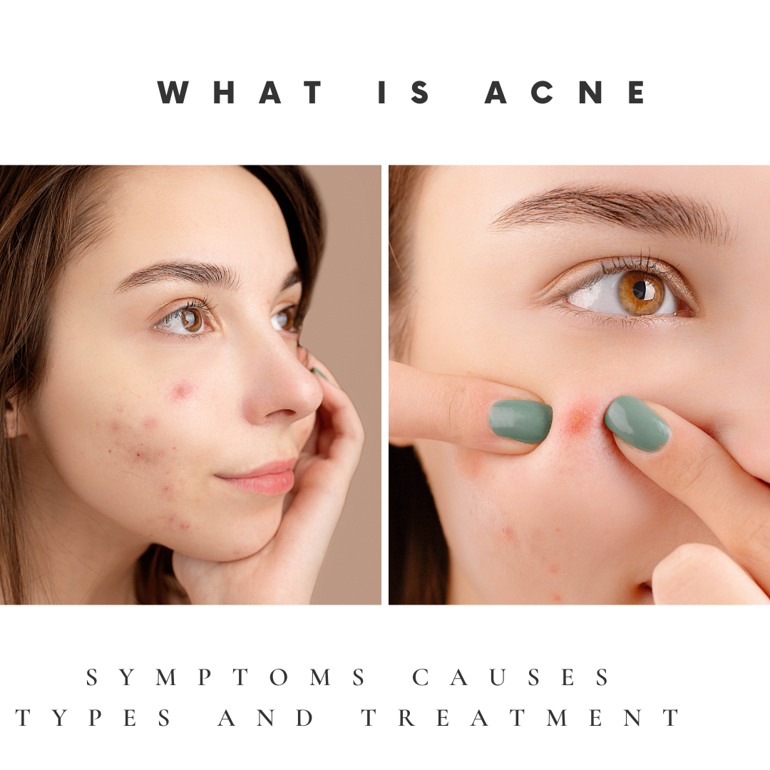 What Is Acne Symptoms Causes Types And Treatment