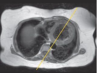 heart mri