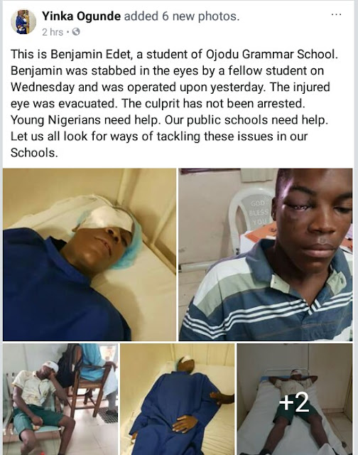  Photos: Student of Ojodu Grammar School stabbed in the eye by fellow student