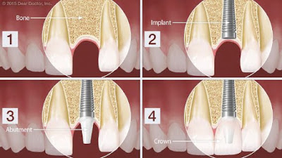 Mất răng có nên Trồng Implant không