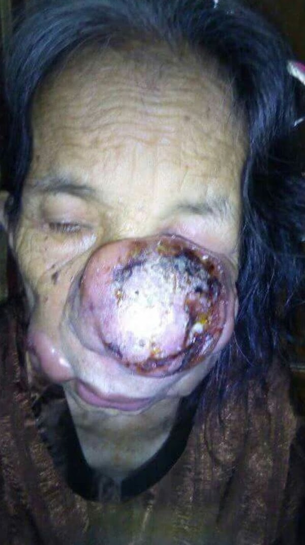 Nenek Hamidah Berusia 78 Tahun mengidap Tumor di Hidung, Butuhkan Bantuan - Metro, Lampung