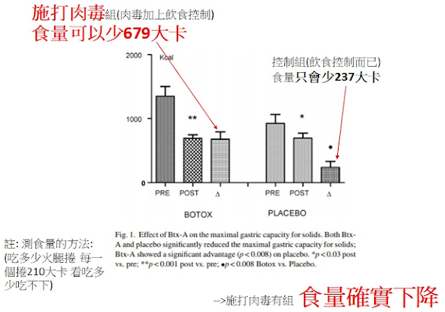 縮胃減重 胃內肉毒 抑制食慾 內視鏡減重 台北