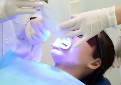 Giới thiệu công nghệ trám răng bằng Laser