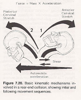 San Diego Chiropractor El Cajon La Mesa Santee Headaches Whiplash