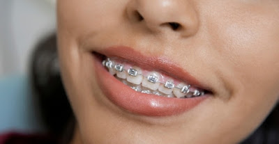 Niềng răng mắc cài kim loại có hiệu quả không? 2