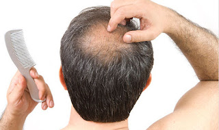 Best home remedies for hair loss