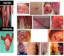 8 Penyakit Berbahaya Bagi Wanita DAn Cara Mengatasinya