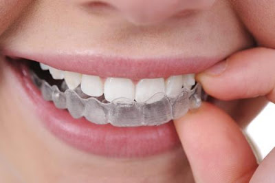 Bleaching dull teeth caused by food with bleaching trough