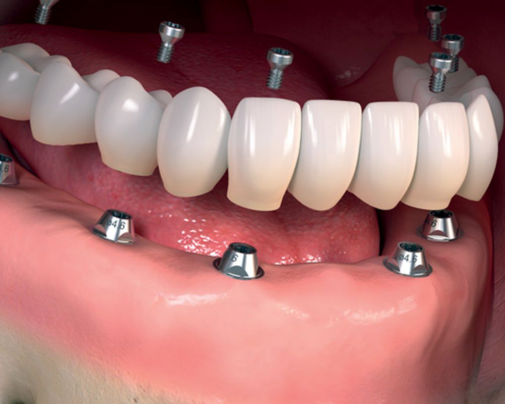 Dental Implants