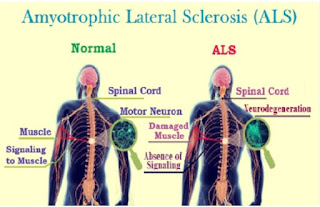 Artikel, Amyotrophic Lateral Sclerosis, Amyotrophic Lateral Sclerosis Adalah, Lou Gehrig, Gejala Amyotrophic Lateral Sclerosis, Penyebab Amyotrophic Lateral Sclerosis, Pengobatan Amyotrophic Lateral Sclerosis