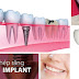 Implant răng cửa là gì