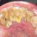 Tips Mudah Menghilangkan Karang Pada Gigi