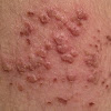 Shingles - Area - Day 16