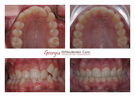 Dental Crossbite, Arch Asymmetry  