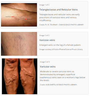 Varicose Veins