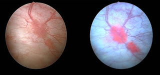 Bladder Cancer Pictures From Cystoscopy