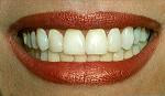 dental implant denture crown Thailand India