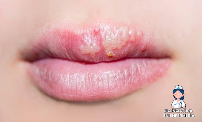 ¿Cuáles son los mejores remedios caseros para el herpes labial?
