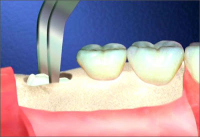 Phân tích răng bị sâu có nên nhổ không từ nha sĩ-2