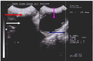 Sỏi thận trái có kích thước 2,08 cm; thận phải ứ nước hoàn toàn, vùng vỏ thận mỏng (mũi tên xanh), vùng tủy thận có hồi âm trống (mũi tên tím).