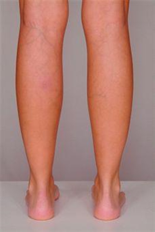 Best herbs and other natural remedies for treating varicose veins (Varicosities)