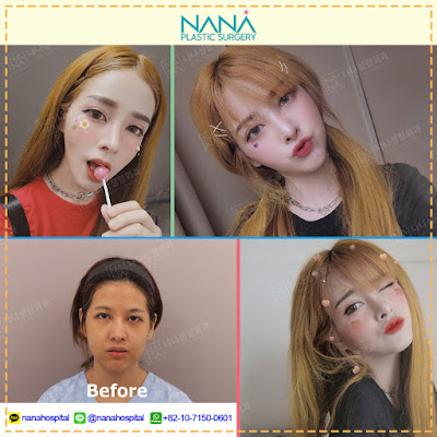 kontur wajah korea, bedah plastik korea, kontur wajah, vline, operasi di korea, operasi korea, operasi plastik di korea, operasi plastik korea, oplas, oplas korea, cantik sempurna, alami