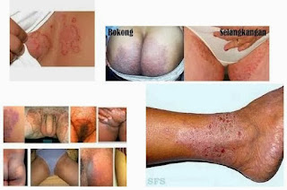 Pengobatan Terhadap Penyakit Eksim Atau Dermatitis