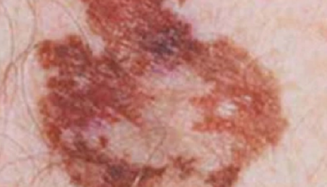malignes melanom Grenzunregelmäßigkeit frühstadium bilder