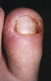 ingrown toenail