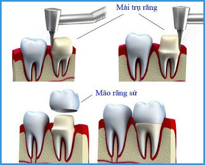 Những trở ngại có thể gặp khi trồng răng sứ nguyên hàm-2