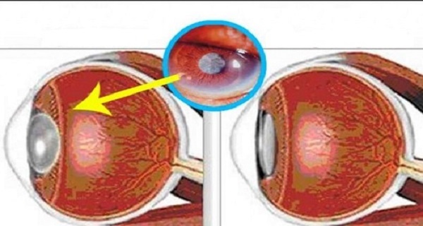 TOLONG SEBARKAN!! Buang Kaca Mata Anda, Ribuan Orang Berhasil Sembuh Dengan Metode Ini.!