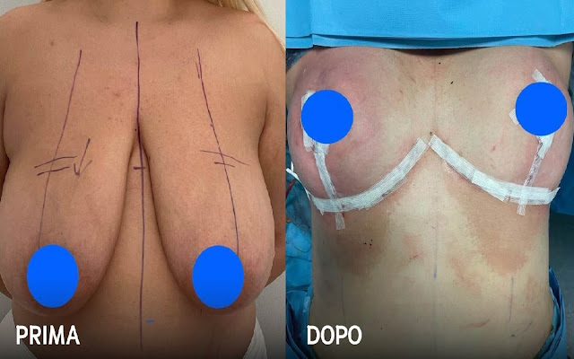 Riduzione del seno prima e dopo, di una donna di 44 anni