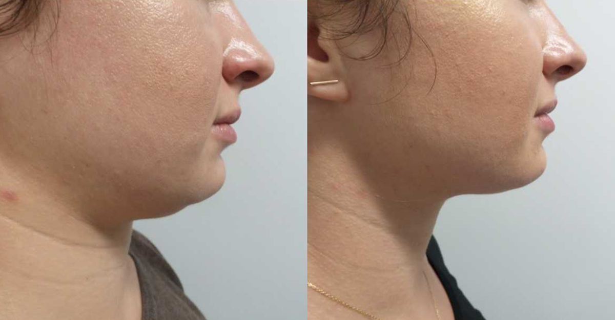 How Kybella Can Help You Get Rid of Your Double Chin?