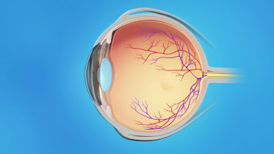 Diabetic retinopathy is an eye disorder that causes damage to the blood vessels of the retina.