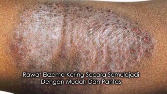 Penyakit Psoriasis,Ekzema,Ruam Bayi Dan Semua Penyakit 