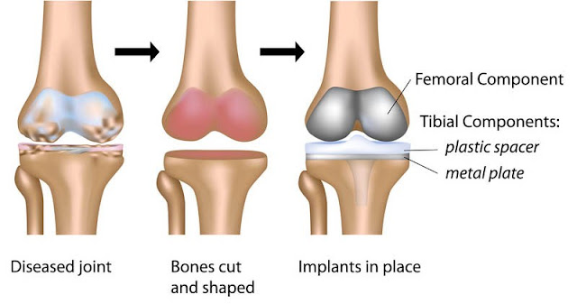 knee replacement surgery