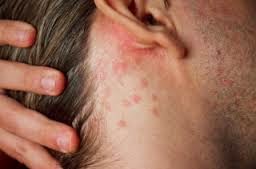 herpes viruses (acne)