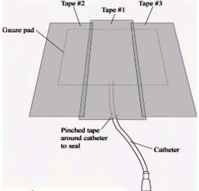 How to Put On a Gauze Dressing 