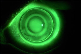 Orthokeratology Lens Market