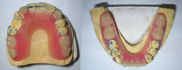 Valplast Removable Felxible Denture