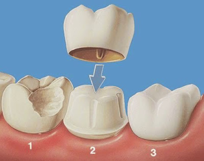 Các phương pháp trồng răng sứ thẩm mỹ